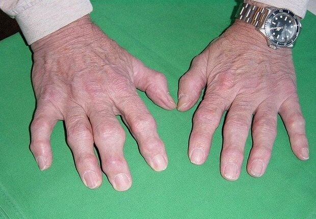 Osteoartritis pada jari