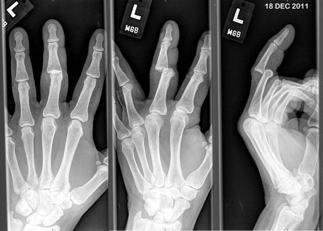 X-ray dari jari-jari yang terkilir