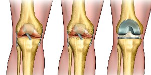 osteoarthritis pengembangan