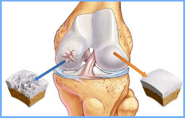 Sendi lutut normal dan terkena arthrosis