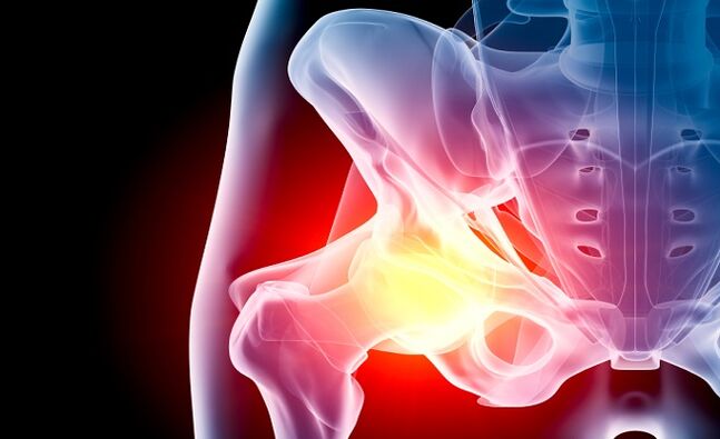 arthrosis sendi panggul