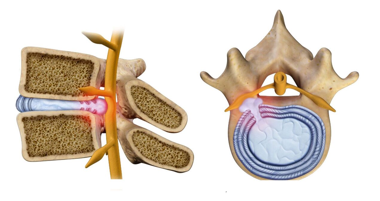 hernia tulang belakang pada osteochondrosis toraks