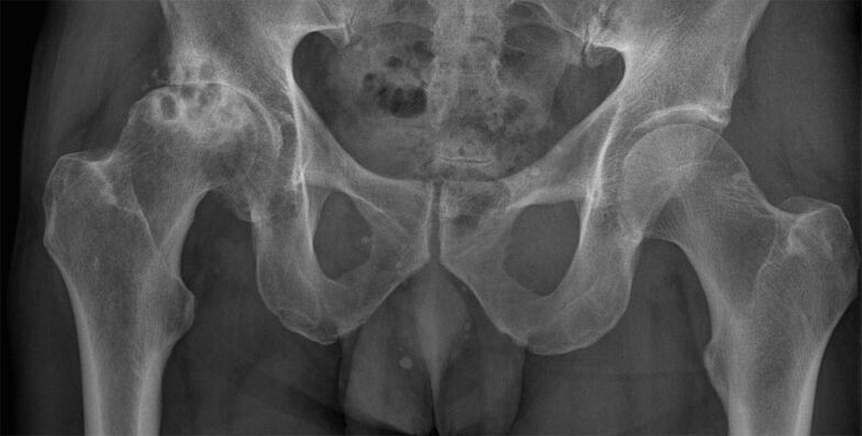 Deformasi arthrosis sendi panggul pada x-ray