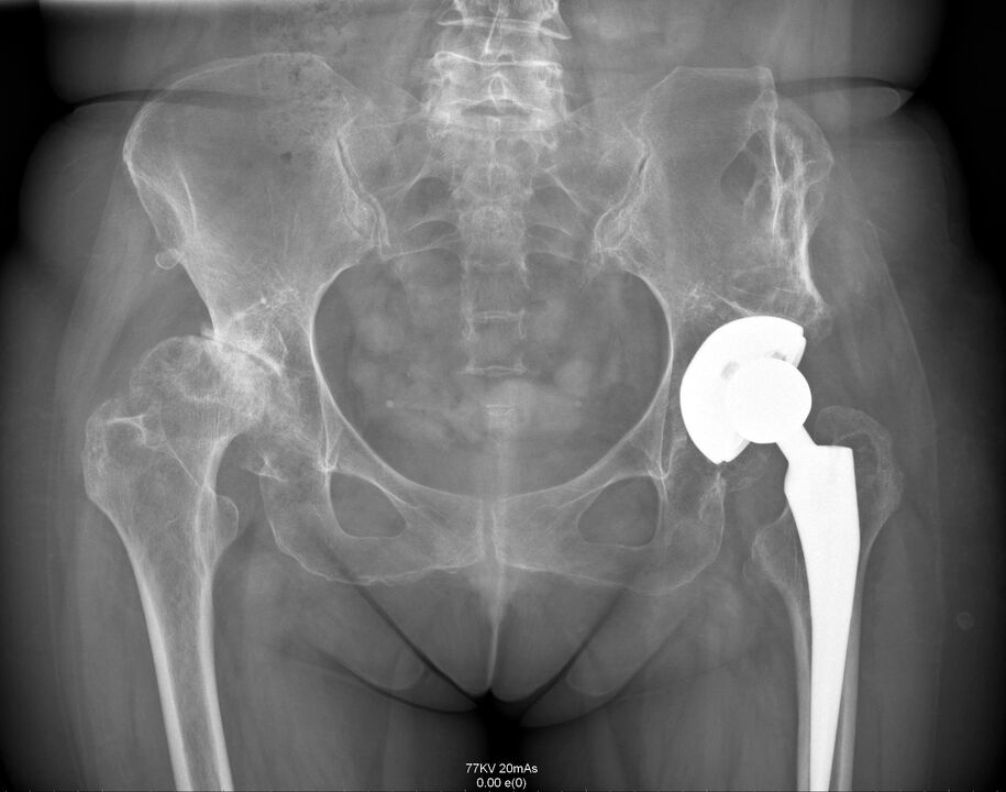 X-ray sendi panggul setelah artroplasti