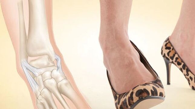 memakai sepatu dengan tumit sebagai penyebab arthrosis pergelangan kaki