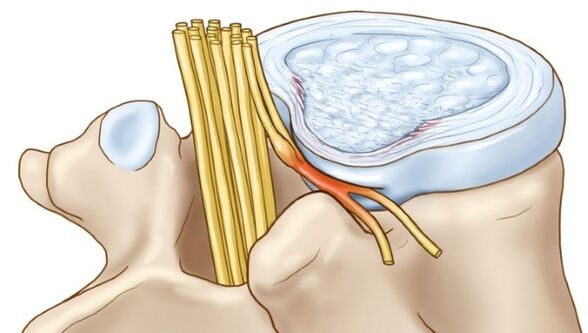 Osteochondrosis lumbal dapat menyebabkan komplikasi berupa hernia intervertebralis