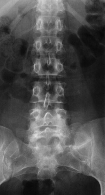 Untuk mendiagnosis osteochondrosis lumbal, radiografi dilakukan