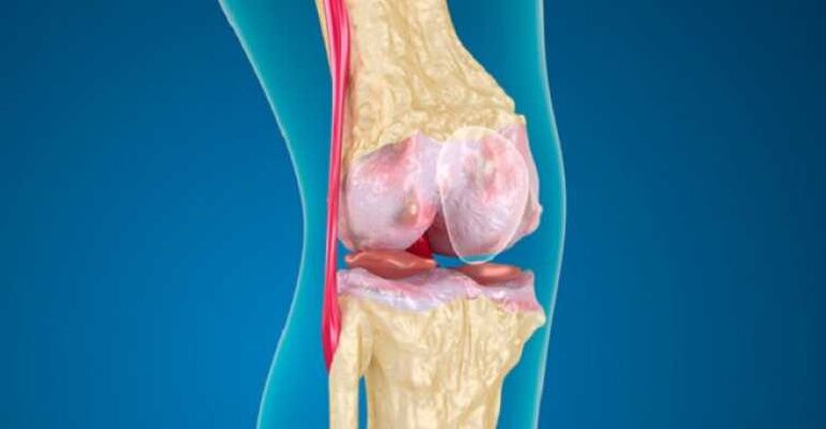 Arthrosis pada penyakit sendi lutut, yang menyebabkan penghancuran tulang rawan pada sendi