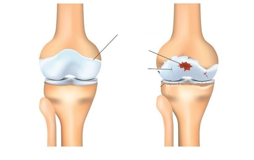 Sehat dan sabar dengan sendi arthrosis