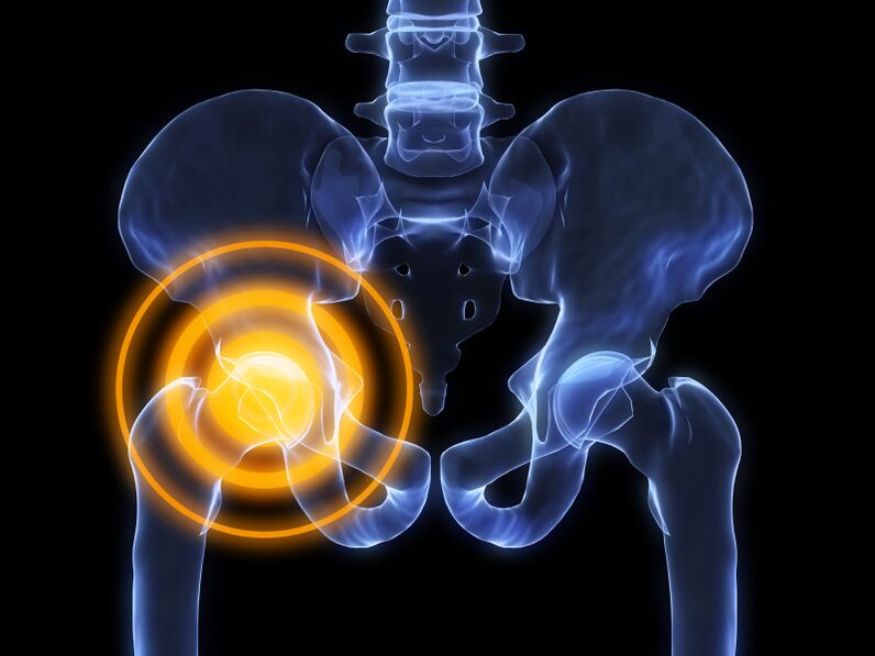 arthrosis sendi panggul