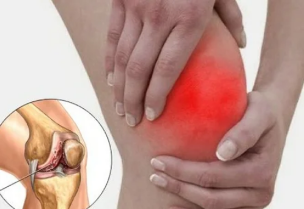 Apa yang terjadi ketika arthritis
